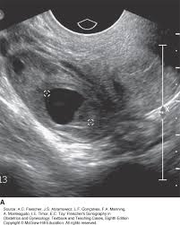 Image result for corpus luteum sonography)