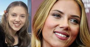 Scarlett Johansson's Smile: From Natural Beauty to Veneers