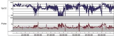 A Pulse Oximetry And Heart Rate Chart During The Polygraphy