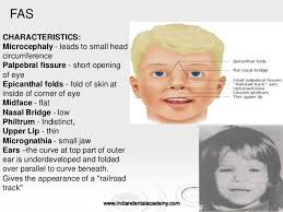 Lengthening the bridge does not affect the epicanthal folds but augmenting the radix at the top of the nose does. Digeorge Syndrome Palpebral Fissures Google Search Digeorge Syndrome Pediatric Nurse Practitioner Good Study Habits