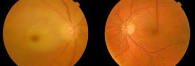 Browse and rate photos uploaded by our community. Treatment Options For Central Retinal Artery Occlusion Springerlink