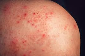 You can look up pictures of petechiae and cherry angioma and compare them. Does Stress Cause Petechiae Lovetoknow