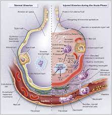Breathing becomes difficult and oxygen cannot get into the body. Acute Respiratory Distress Syndrome Acute Hypoxemic Respiratory Failure Non Cardiogenic Pulmonary Edema High Permeability Pulmonary Edema Cancer Therapy Advisor