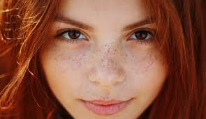 Image result for Freckles