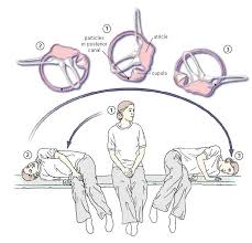Image result for Canalith Repositioning Procedure