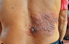Gurtelrose Bilder Und Symptome Von Herpes Zoster