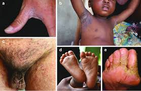 Image result for scabies on humans