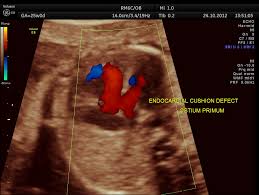 Image result for Endocardial Cushion Defect