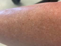 Image result for liver spots on legs