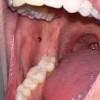 The main cause of blood blisters is commonly the excessive pressure received by the affected area. 3