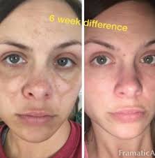 Avoid the eye area and lips. People Love This Dark Spot Serum On Amazon