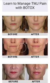 After all, when a cosmetic injectable is placed under the skin, it works to relax the muscles along the area. Facebook