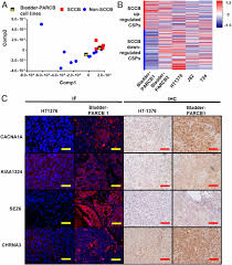 Patients usually present with hematuria (most commonly) or irritative voiding symptoms. A Genetically Defined Disease Model Reveals That Urothelial Cells Can Initiate Divergent Bladder Cancer Phenotypes Pnas