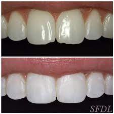 Front Teeth Chipped Sugar Fix Dental Loft Chipped Tooth Teeth Front Teeth