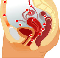 It affects women in their reproductive years and causes chronic pelvic pain often associated with menstruation. Ø§Ù†ØªØ¨Ø§Ø° Ø¨Ø·Ø§Ù†ÙŠ Ø±Ø­Ù…ÙŠ Ø§Ù„Ù…Ø¹Ø±ÙØ©