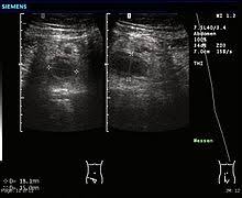 Learn vocabulary, terms and more with flashcards, games and other study tools. Appendicitis Wikipedia
