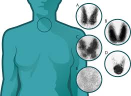 Graves' eye disease, also known as thyroid eye disease, is an autoimmune condition in which immune cells attack the thyroid gland which responds by secreting an excess amount of thyroid hormone. Technetium 99 Thyroid Uptake Scans A Normal B Graves Disease Download Scientific Diagram