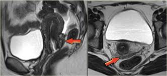 Learn about treatment, causes, stages, surgery, and diagnosis. The Radiology Assistant Endometriosis Mri Detection