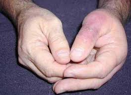 Because anyone can post something gnarly like this and call it a brown recluse bite. Brown Recluse Spider Bite Pictures Symptoms Treatment Stages