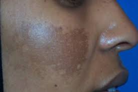 Image result for Melasma calycinum