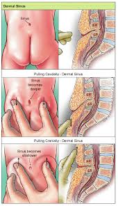 Image result for Spinal Dysraphism