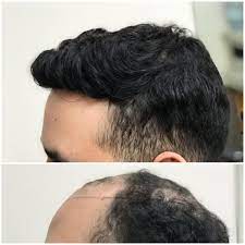 Male Hair Loss Solutions Hairstyles Cnc Cesare Ragazzi Hair Loss Men Hair Loss Solutions Losing Hair Women