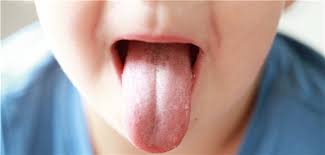 Von hautausschlägen berichten forscher dabei schon seit längerem. Arzt Befreit Zunge Mit Altem Weintrick