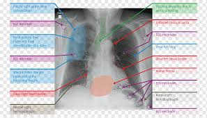 Check spelling or type a new query. Chest Radiograph X Ray Lung Thorax Heart Soft Lines Angle Text Service Png Pngwing