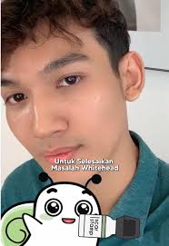 Hilangkan Blackhead dan Whitehead dengan Scar Roller