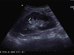 Dromedary hump is characterised by a high content, at about two third, in saturated fatty acids. Dromedary Hump Prominent Focal Bulges Arrow On The Lateral Border Of Download Scientific Diagram