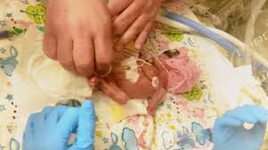 Day of the year is a number between 1 and 365 (in 2021), january 1 is day 1. Baby Born At 24 Weeks With Feet The Size Of Pennies Beats All Odds Youtube