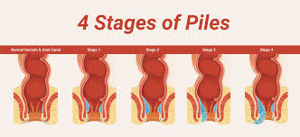 Stages Of Piles A Pictorial Representation In 2020 Elective Surgery Hemorrhoids Hemorrhoids Treatment