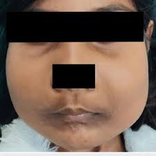 Facial appearance of the patient showing no definite resolution of...