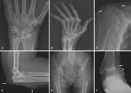 Image result for XRay Changes in Rheumatic Conditions