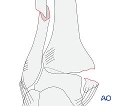 An oblique medial malleolus fracture may also. Suprasyndesmotic Simple Fibular Fracture Medial Injury Posterior Fracture