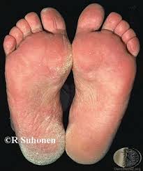 Rifter og sår på hendene kan skyldes en skade, eller rett og slett tørr hud som over tid blir tykkere og sprekker opp. Soppinfeksjoner Soppinfeksjon I Hodebunn Oslo Hudlegesenter