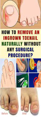 Soften The Skin Around Your Toenail With Olive Oil And Gently Push It Away From The Nail With A Cotton Bud Wet A Cott Ingrown Toe Nail Toe Nails How To