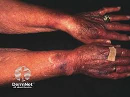 Image result for Systemic Corticosteroid