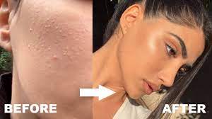 Eating less meat and dairy can also be beneficial. How I Got Rid Of Stubborn Bumps And Textured Skin Youtube