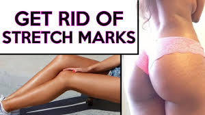 This stimulates the tissues around your stretch marks. How To Get Rid Of Stretch Marks Fast Naturally At Home With Overnight Remedies Healthrave