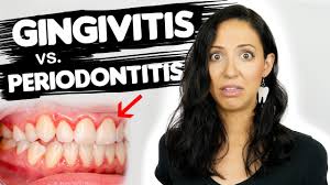 Gingivitis is an inflammatory process limited to the mucosal epithelial tissue surrounding the cervical gingivitis has been classified by clinical appearance (eg, ulcerative, hemorrhagic, necrotizing. Do You Have Gingivitis Or Periodontitis Different Stages Of Gum Disease Youtube
