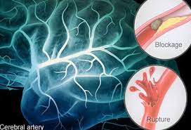 They happen the same way other strokes do, by a blockage of blood flow. Stroke Causes Symptoms And Recovery