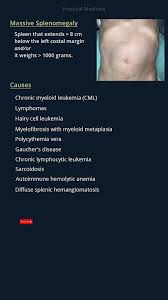 Image result for Splenomegaly