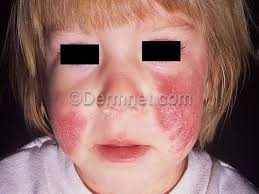 Dr.MOHAMED NASR Lecturer Of Dermatology & Venereology Zagazig University  Eczema.