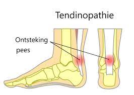 Pijnlijke Achillespees Tendinopathie Dr Afcm Sjors Moonen Voet Enkel Specialist