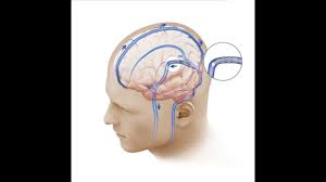 Pseudotumor Cerebri Youtube