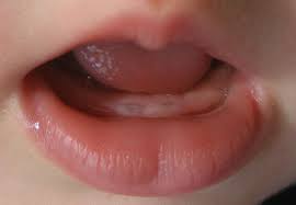 Carie la haine 2012, source:docteurcarie.blogspot.com. Poussees Dentaires Jusqu A Quel Age Bord A Bord Tourisme Nautique