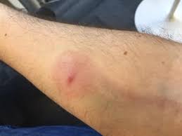 As with most insects, spiders will bite as a way of defending themselves, and you can. Spider Bite In Edinburgh Garage Left Father At Risk Of Blood Poisoning Heraldscotland