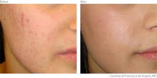 Maybe you would like to learn more about one of these? Acne Scar Treatment Laser For Acne Scar Removal Lumenis