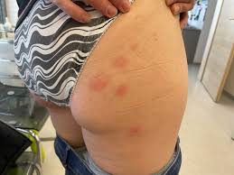 Image result for Trombicula autumnalis bites